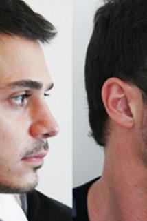 Profilový obrázek - Beard Transplants Are Real